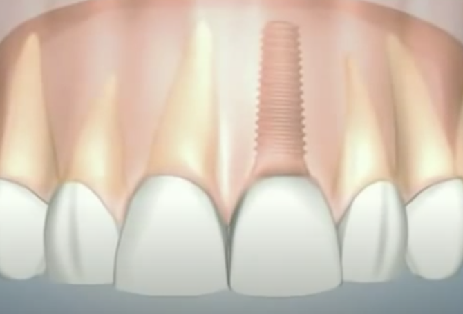 WNY Dental Implants