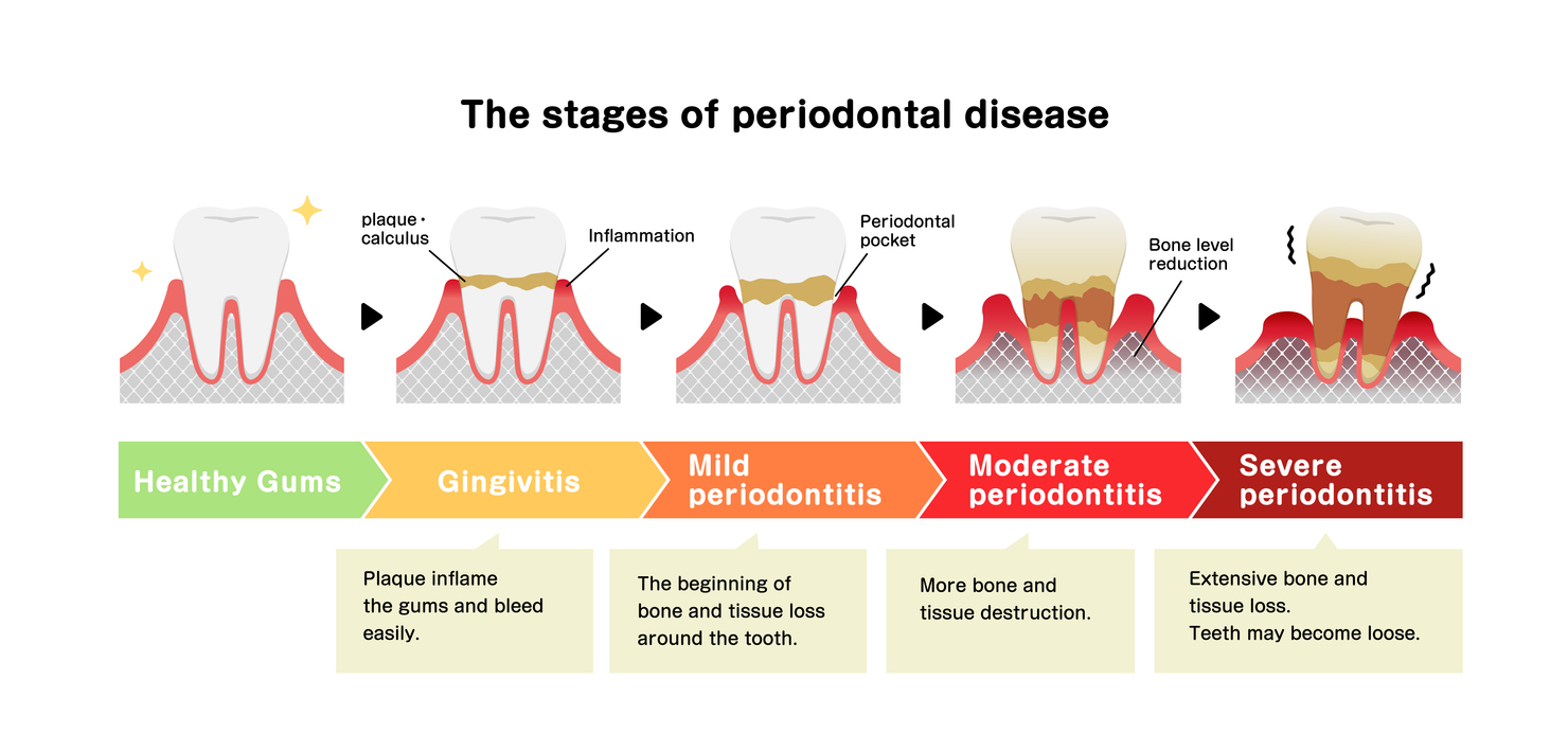 The stages of periodontitis disease 