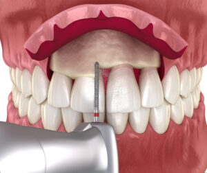 Frontal crown lengthening, Esthetic surgery. Medically accurate dental