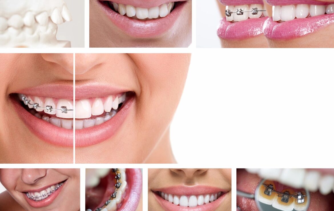 How Do Braces Work?