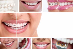 How Do Braces Work?