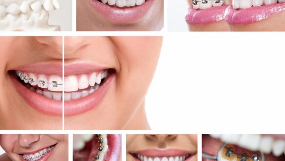 How Do Braces Work?